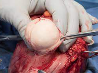 Fibroid Removal Treatment