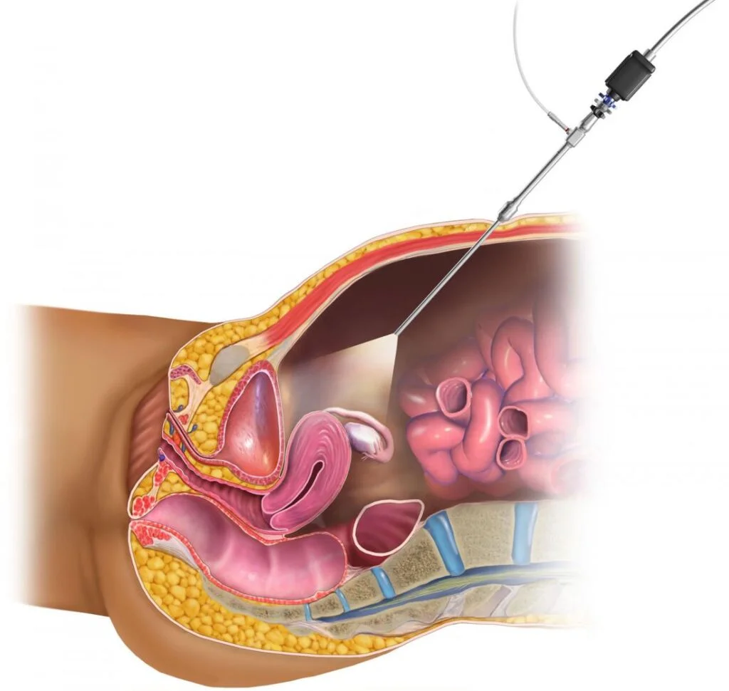 Laparoscopy for infertility